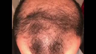 6 months using minoxidil  Rogaine 5 Before amp After results [upl. by Melquist]