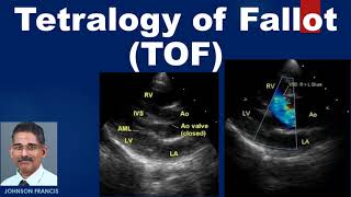 Tetralogy of Fallot TOF [upl. by Dulcie347]