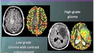 Doctor Explains Glioma Brain Tumor [upl. by Anavi]