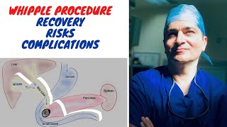 WHIPPLE PROCEDURE RECOVERY RISKS and COMPLICATIONS [upl. by Haibot]