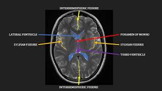 Glioblastoma Multiforme what you need to know [upl. by Wat]