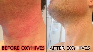 How To Get Rid Of Hives With The OxyHives Hives Treatment [upl. by Trutko]