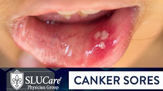 Determining Causes amp Treatment for Canker Sores  SLUCare Otolaryngology [upl. by Imiaj588]