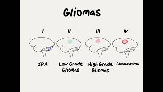 Imaging brain tumors  2  Astrocytomas [upl. by Mellins]