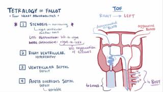 Tetralogy of Fallot 4 vessel view with colour Doppler [upl. by Franny410]