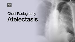 Chest Radiography Atelectasis [upl. by Ennovaj]