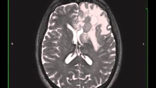 Grade 3 Anaplastic Astrocytoma [upl. by Ranice]