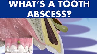 TOOTH ABSCESS dental infection  PHLEGMON symptoms and treatment © [upl. by Slen]