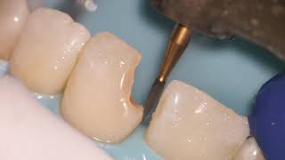 Teeth Bonding  Front tooth filling EXPLAINED [upl. by Frodi]