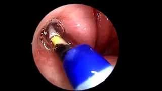 Eustachian Tube Balloon Dilation [upl. by Specht731]