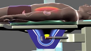 Shockwave Lithotripsy [upl. by Ynos]