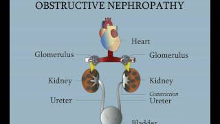 Ureteral Stents Complications and Innovations [upl. by Ebner]