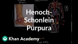 HenochSchonlein purpura  Circulatory System and Disease  NCLEXRN  Khan Academy [upl. by Nahaj496]