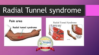 Radial Tunnel Syndrome [upl. by Seuqcaj755]