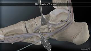 Flexor Digitorum Longus FDL Tendon Transfer [upl. by Maren]