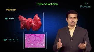 Multinodular goitre  Usmle step 1 pathology lecture and case presentation [upl. by Magena]