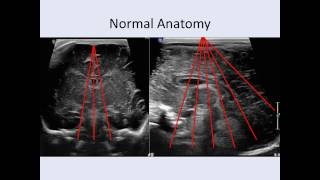 Cranial Ultrasound Anatomy [upl. by Haram]