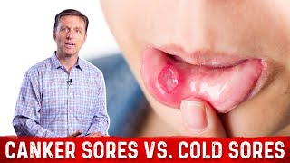 Canker Sores Vs Cold Sores – Dr Berg on Mouth Sores [upl. by Broderic]